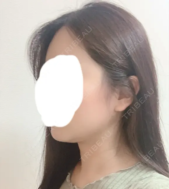 糸リフト / 骨切り（あご） / 骨削り（エラ） / 骨削り（頬） / 脂肪吸引（顔） RG整形外科（旧リオン整形外科） DAY 188 メイン用