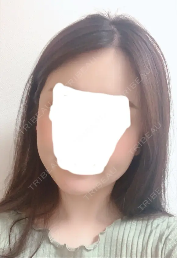 糸リフト / 骨切り（あご） / 骨削り（エラ） / 骨削り（頬） / 脂肪吸引（顔） RG整形外科（旧リオン整形外科） DAY 188 メイン用