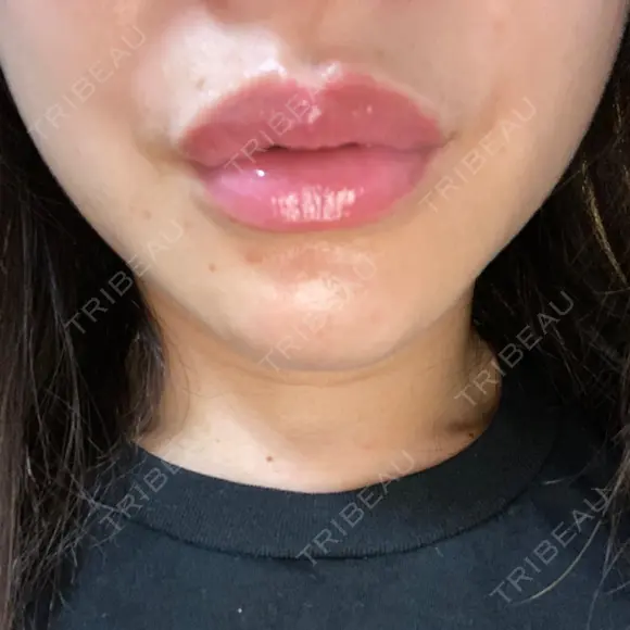 アートメイク（唇） BMC CLINIC 南青山 DAY 3 メイン用