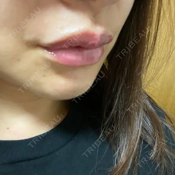 アートメイク（唇） BMC CLINIC 南青山 DAY 3 メイン用