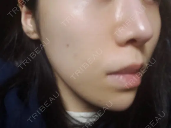 ニキビ治療 品川美容外科 仙台院 DAY 2 メイン用