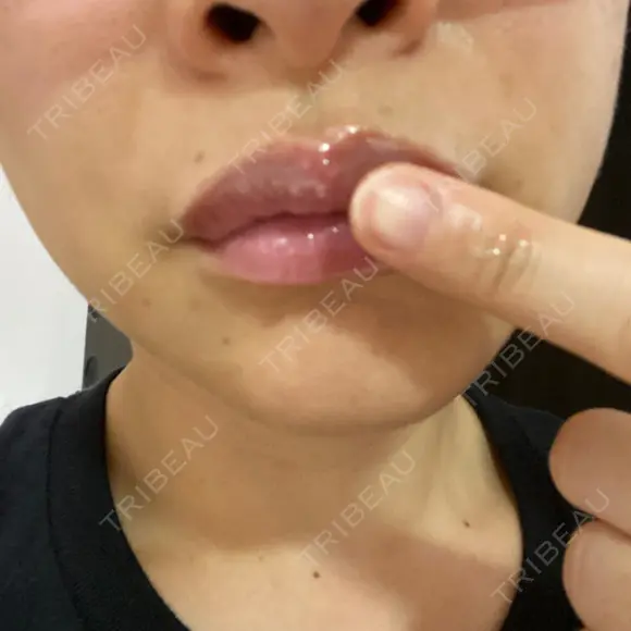 アートメイク（唇） BMC CLINIC 南青山 DAY 4 メイン用