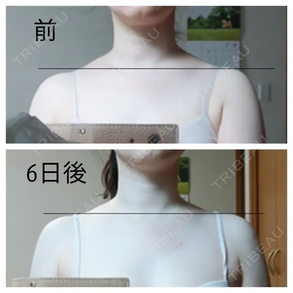 ボトックス（肩） もとび美容外科クリニック 新宿院 DAY 6 メイン用