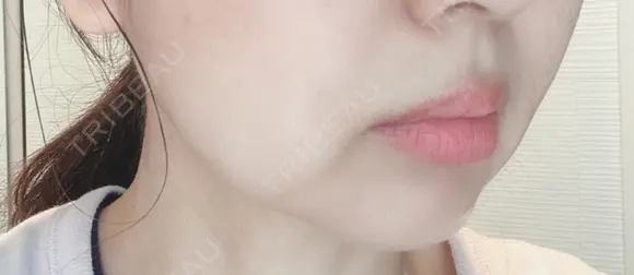 脂肪溶解注射（顔） 赤坂プレミアクリニック DAY 7 メイン用