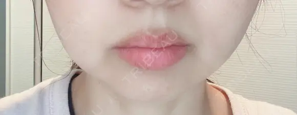 脂肪溶解注射（顔） 赤坂プレミアクリニック DAY 7 メイン用