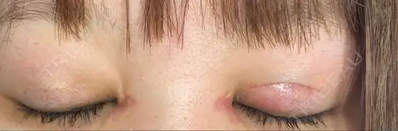 二重切開 / 目頭切開 / 上まぶたたるみ取り / 上まぶたの脂肪取り 湘南美容クリニック 広島院 DAY 54 メイン用