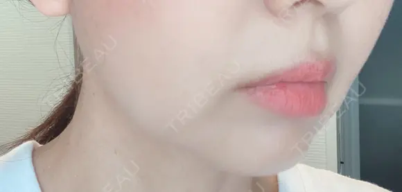 脂肪溶解注射（顔） 赤坂プレミアクリニック DAY 8 メイン用