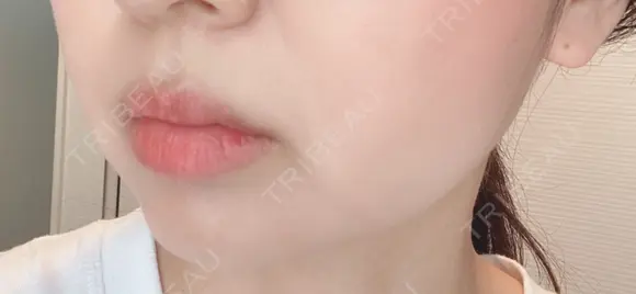 脂肪溶解注射（顔） 赤坂プレミアクリニック DAY 8 メイン用