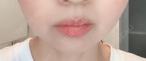 脂肪溶解注射（顔） 赤坂プレミアクリニック DAY 8 メイン用