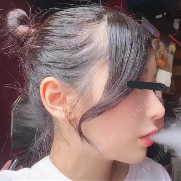 隆鼻術 / 鼻尖形成（切開） / 鼻中隔延長（切開） / 小鼻縮小（切開） / 軟骨移植 HANABI整形外科 AFTER メイン用