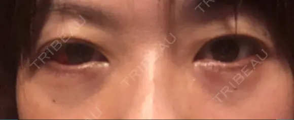 下まぶたの脂肪取り 水戸中央美容形成クリニック DAY 0 メイン用