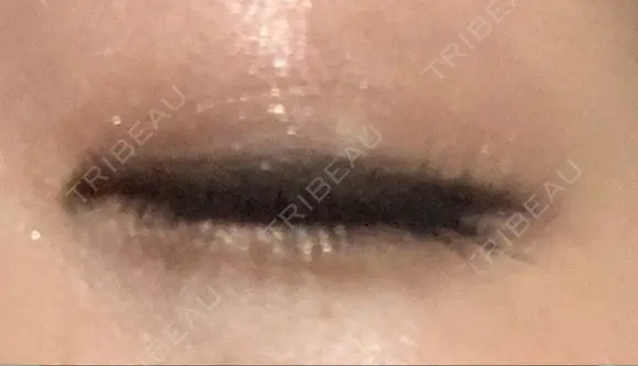 二重埋没 / 脂肪吸引（顔） 表参道スキンクリニック 表参道院 AFTER メイン用