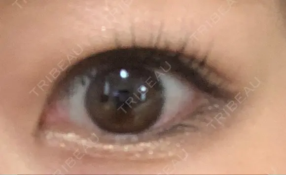 二重埋没 / 脂肪吸引（顔） 表参道スキンクリニック 表参道院 DAY 46 メイン用