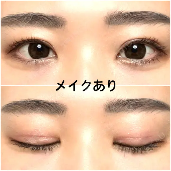 二重切開 / 上まぶたたるみ取り 広島プルミエクリニック DAY 91 メイン用