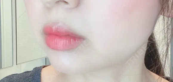 脂肪溶解注射（顔） 赤坂プレミアクリニック DAY 9 メイン用