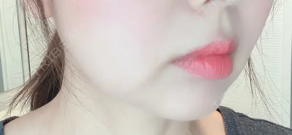 脂肪溶解注射（顔） 赤坂プレミアクリニック DAY 9 メイン用