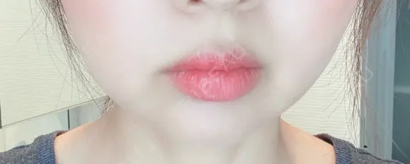 脂肪溶解注射（顔） 赤坂プレミアクリニック AFTER メイン用