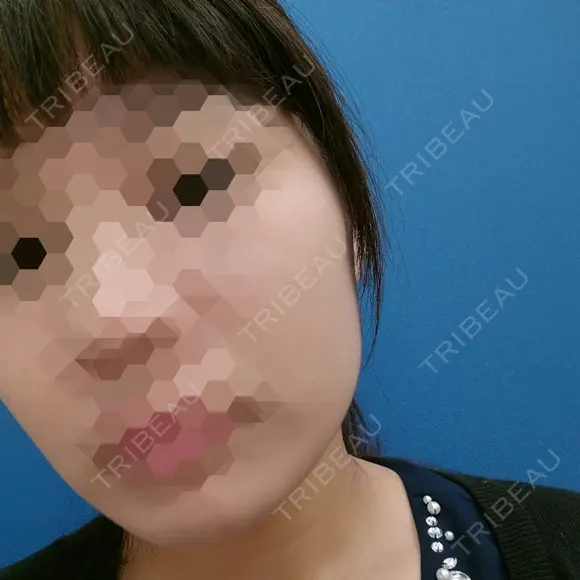 ボトックス（エラ・小顔） 湘南美容クリニック 静岡院 DAY 16 メイン用