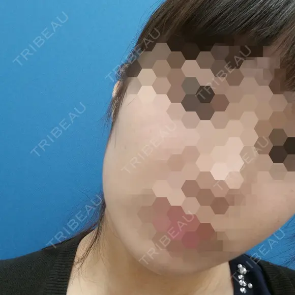 ボトックス（エラ・小顔） 湘南美容クリニック 静岡院 DAY 16 メイン用