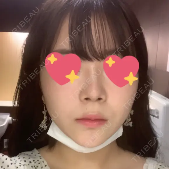 ヒアルロン酸注入（鼻） 青山外苑前クリニック DAY 0 メイン用