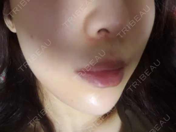 ニキビ治療 品川美容外科 仙台院 DAY 8 メイン用