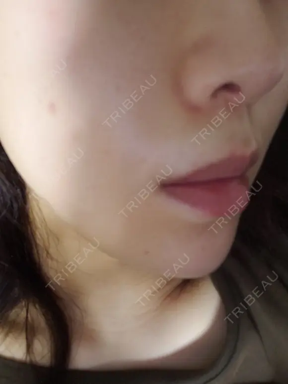 ニキビ治療 品川美容外科 仙台院 DAY 8 メイン用