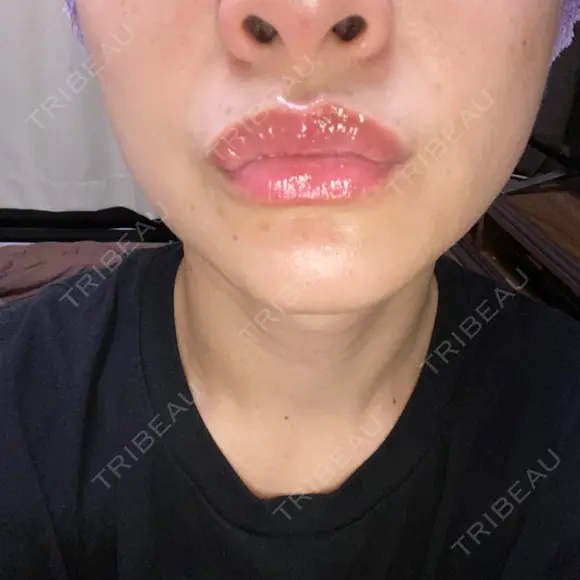 アートメイク（唇） BMC CLINIC 南青山 DAY 10 メイン用