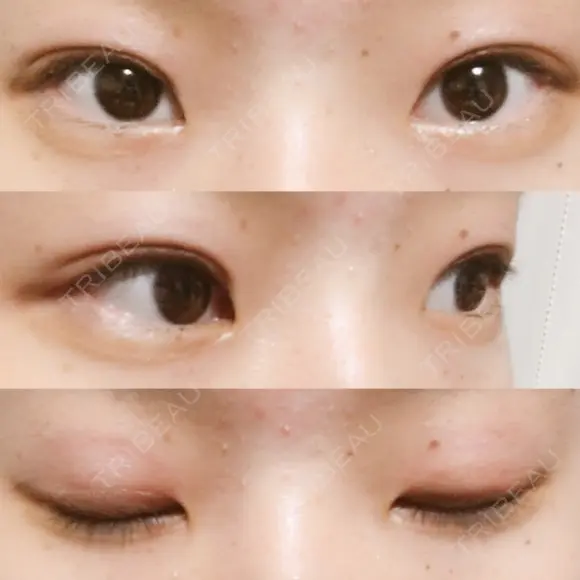 二重埋没 湘南美容クリニック 大阪堺東院 DAY 31 メイン用