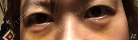 下まぶたの脂肪取り 水戸中央美容形成クリニック DAY 3 メイン用