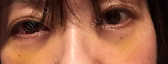 下まぶたの脂肪取り 水戸中央美容形成クリニック AFTER メイン用