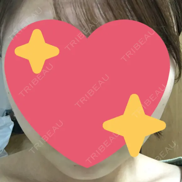 脂肪吸引（顔） / ボトックス（エラ・小顔） 銀座マイアミ美容外科 DAY 6 メイン用