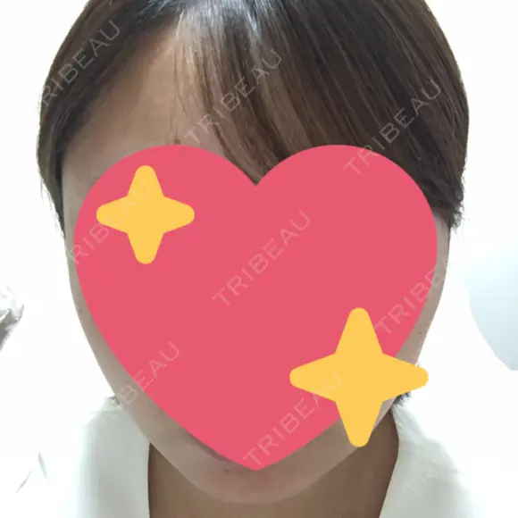 脂肪吸引（顔） / ボトックス（エラ・小顔） 銀座マイアミ美容外科 DAY 8 メイン用