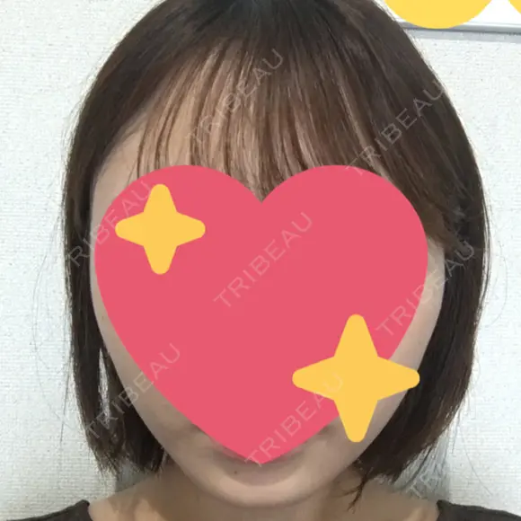 脂肪吸引（顔） / ボトックス（エラ・小顔） 銀座マイアミ美容外科 AFTER メイン用