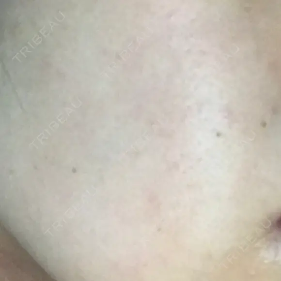 ピーリング（ニキビ・毛穴） 自由が丘クリニック DAY 45 メイン用