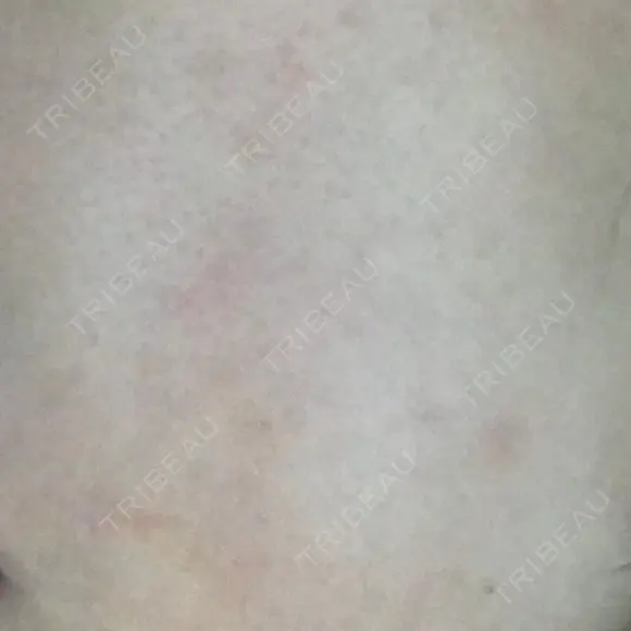 ピーリング（ニキビ・毛穴） 自由が丘クリニック AFTER メイン用