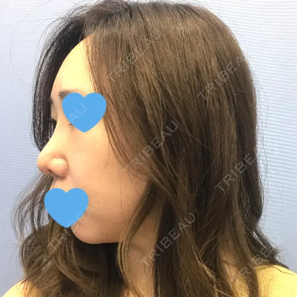 鼻尖形成（切開） / 軟骨移植 / 眉間プロテーゼ / 鼻尖縮小 湘南美容クリニック 柏院 DAY 35 メイン用