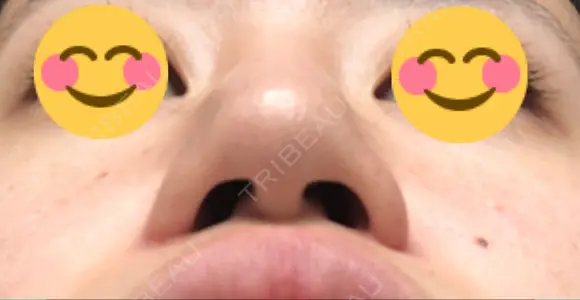 鼻尖形成（切開） / 小鼻縮小（切開） / ヒアルロン酸注入（鼻） 東京ヒルズクリニック 新宿院 DAY 224 メイン用