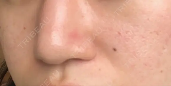 鼻尖形成（切開） / 小鼻縮小（切開） / ヒアルロン酸注入（鼻） 東京ヒルズクリニック 新宿院 DAY 224 メイン用