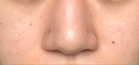 鼻尖形成（切開） / 小鼻縮小（切開） / ヒアルロン酸注入（鼻） 東京ヒルズクリニック 新宿院 AFTER メイン用