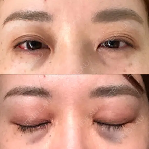 クマ治療 / 下まぶたの脂肪取り TCB東京中央美容外科 中野院 DAY 0 メイン用