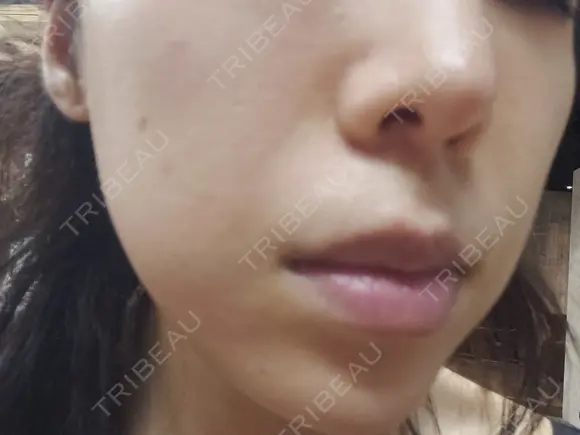 ニキビ治療 品川美容外科 仙台院 AFTER メイン用