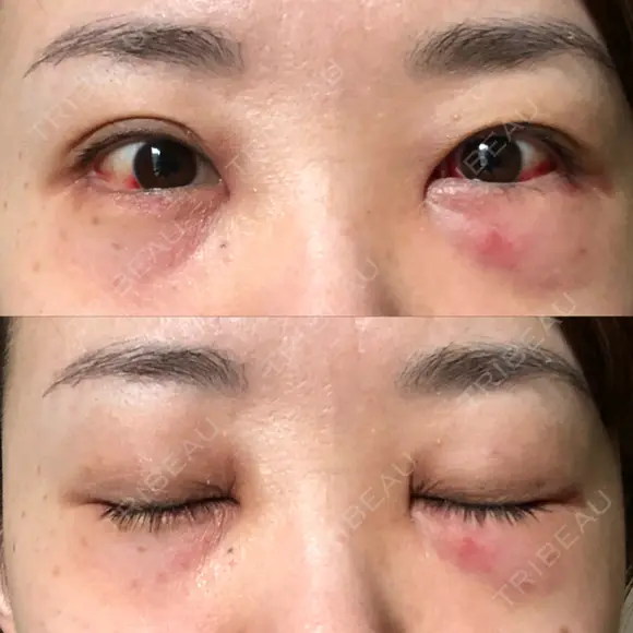 クマ治療 / 下まぶたの脂肪取り TCB東京中央美容外科 中野院 DAY 1 メイン用