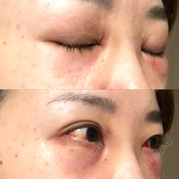 クマ治療 / 下まぶたの脂肪取り TCB東京中央美容外科 中野院 DAY 1 メイン用