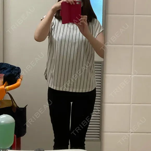 脂肪吸引（脚） / 豊胸（脂肪注入） 南クリニック DAY 31 メイン用