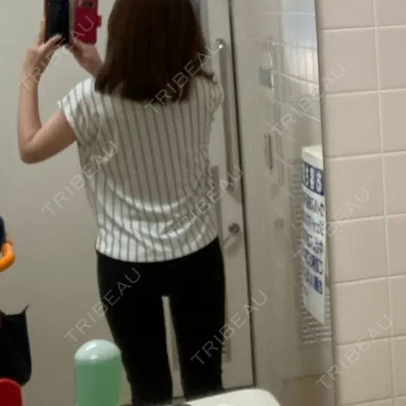 脂肪吸引（脚） / 豊胸（脂肪注入） 南クリニック DAY 31 メイン用