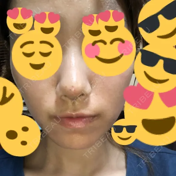 小鼻縮小（切開） / スレッドノーズ / ヒアルロン酸注入（鼻） キップン整形外科 DAY 5 メイン用