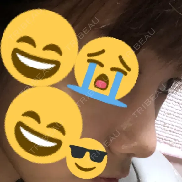 小鼻縮小（切開） / スレッドノーズ / ヒアルロン酸注入（鼻） キップン整形外科 DAY 5 メイン用