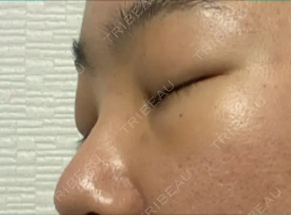 下まぶたの脂肪取り SOグレイスクリニック 御殿山 DAY 3 メイン用