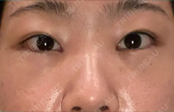 下まぶたの脂肪取り SOグレイスクリニック 御殿山 DAY 4 メイン用