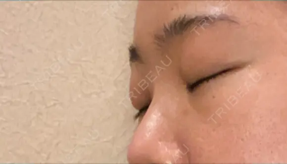 下まぶたの脂肪取り SOグレイスクリニック 御殿山 DAY 4 メイン用